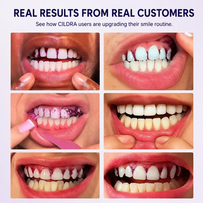 CILDRA™ Purple Whitening Strips